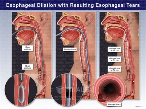 Esophageal Dilation with Resulting Esophageal Tears - TrialExhibits Inc.