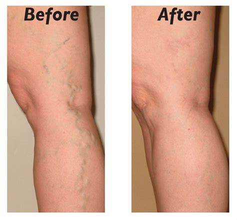 Laser hair removal and Sclerotherapy