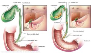 Calculs biliaires - Canadian Liver Foundation