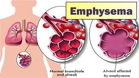 IMC | Emphysema - Symptoms And Causes