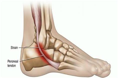 Podiatrists for Peroneal Tendon Surgery in Edgemont