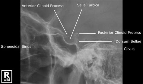 Sella Turcica Radiographic Anatomy - wikiRadiography | Radiology student, Radiology schools ...