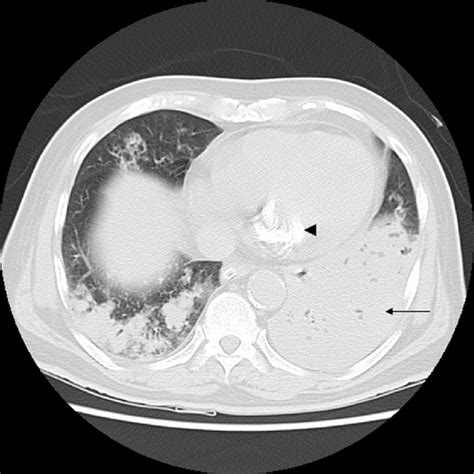 Incidental mitral annular calcification (arrowhead) is seen. Thin arrow ...