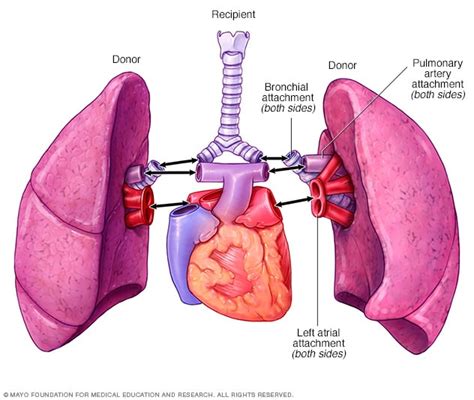 Double-lung transplant - Mayo Clinic