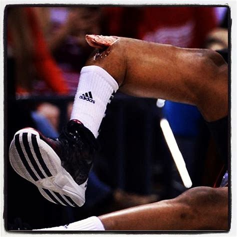 The worst basketball injury I have EVER seen in my life... | Flickr ...