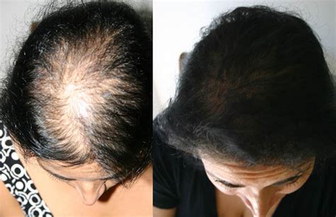 Female Hair Loss Patient 1 | Limmer Hair Transplant Center