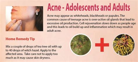 Natural Remedies for Acne | Mother Of Health