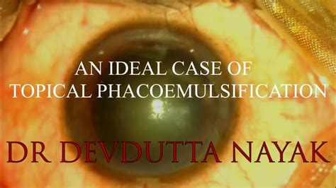 AN IDEAL CASE OF TOPICAL PHACOEMULSIFICATION - YouTube