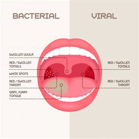 Chronic Pharyngitis: Symptoms, Causes, Home Remedies | STD.GOV Blog