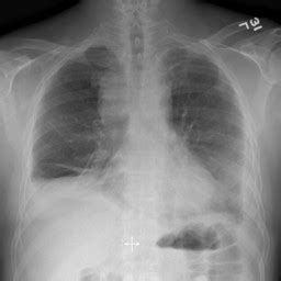 Exported SVC SYNDROME