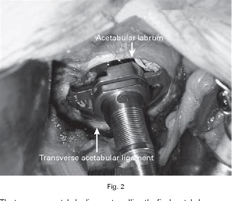 [PDF] The Transverse Acetabular Ligament: an Aid to Orientation of the Acetabular Component ...