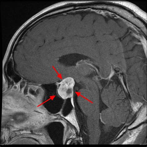 Pituitary Tumor - Signs, Symptoms, Diagnosis, MRI, Surgery & Treatment