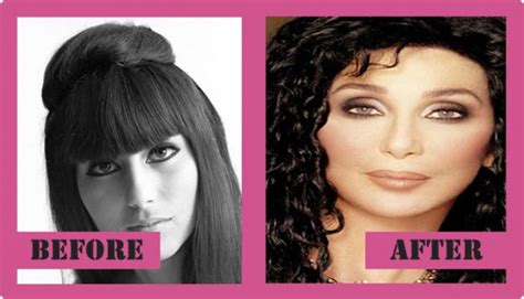 Cher Plastic Surgery - And Why She Needs It