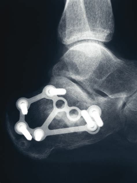 life after a calcaneus fracture surgery - Elise Candelaria