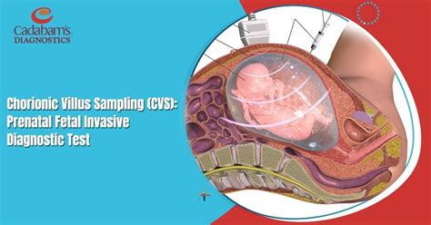 Chorionic Villus Sampling (CVS): Prenatal Fetal Invasive Diagnostic Test