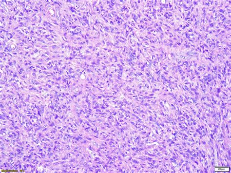 Fibrous Histiocytoma