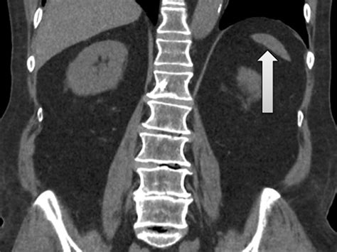 A case of autosplenectomy associated with T-cell checkpoint inhibitor treatment | BMJ Case Reports