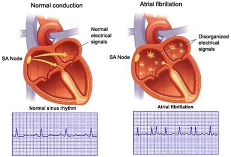 Know About Cardiac Arrhythmia – Irregular Heartbeat | Kauvery Hospital