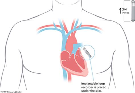 Loop Recorder | Cardiovascular Consultants of South Georgia