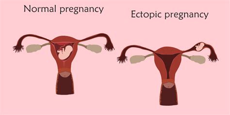 Symptoms of Ectopic Pregnancy - Pristyn Care