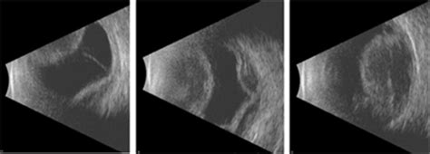 Choroidal Detachment - Patients - The American Society of Retina Specialists