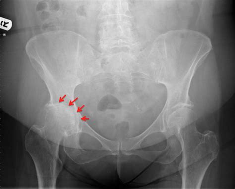 Osteoarthritis X Ray Hip