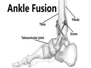 Ankle Fusion | Orthopedic Surgeon Hospital Treatment Cost Surgery