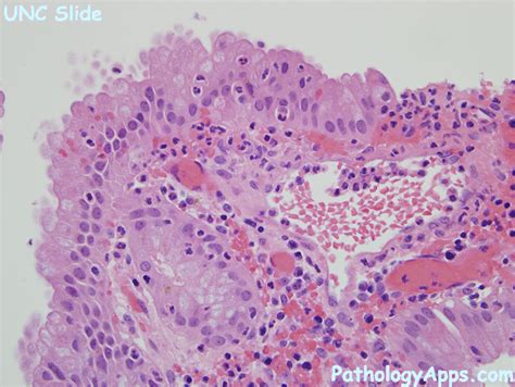 acute cholecystitis biliary tract histology