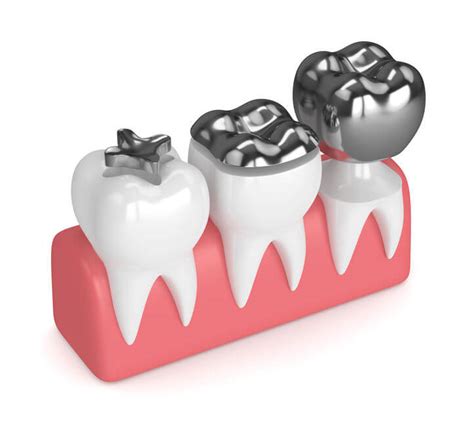 Removing Amalgam Fillings - Side Effects to Note | GundryMD