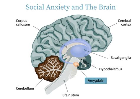 Causes of Social Anxiety – Bridges to Recovery