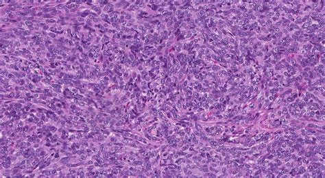 Thymoma type A | Atlas of Pathology