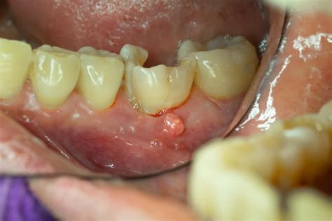 Periodontal disease stages and how to manage them | etransplus.com