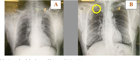 Figure 1 from A delayed complication of a port-a-cath insertion via ...