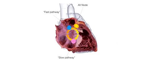 SVT EP Study & Ablation - One Heart Cardiology