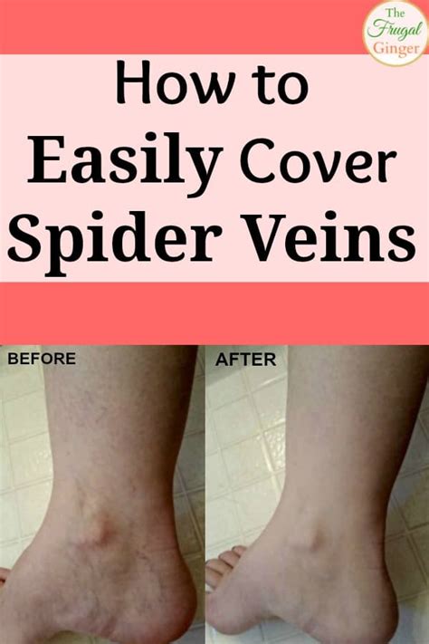 The Best Cover Up Makeup For Varicose Veins - Mugeek Vidalondon