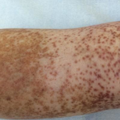 Granulomatous Pigmented Purpuric Dermatosis | MDedge Dermatology