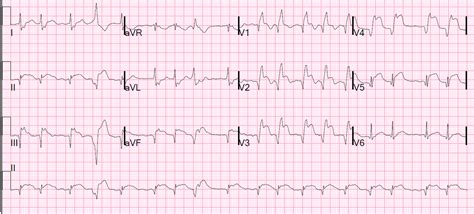 Dr. Smith's ECG Blog: Large Transmural STEMI with Myocardial "Rupture ...