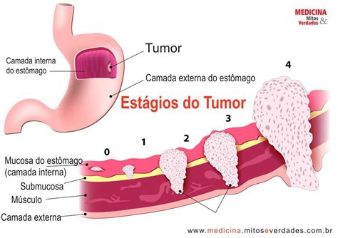 Tumor Estomago Sintomas - SEO POSITIVO