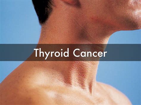 Thyroid Cancer