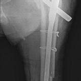 X-Ray showed fracture of the femoral shaft fracture during PFNA... | Download Scientific Diagram