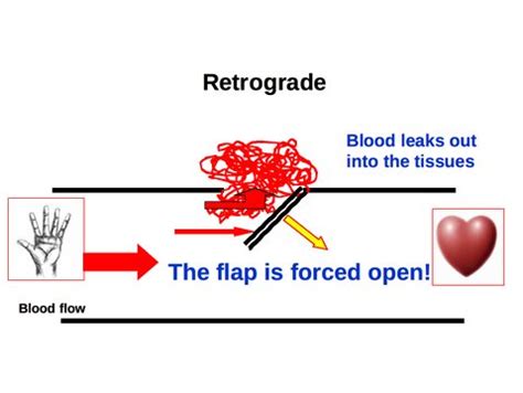 Rethinking AVF Needling Techniques - (Make both “pointy ends” face towards the heart!) - Home ...