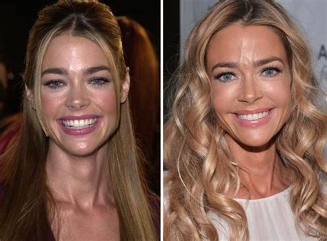 Denise Richards before and after plastic surgery 40 – Celebrity plastic ...