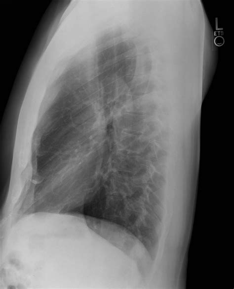 File:Chest Xray Lateral 3-8-2010.png - Wikimedia Commons