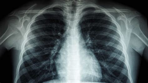 Tackling Tuberculosis: How Singapore Is Taking A Proactive Stance Against The Disease