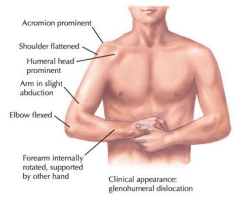 The Complete Guide to Shoulder Instability | Kinetic Labs