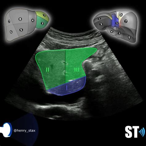 Couinaud’s Liver Segments – Sonographic Tendencies | Segmentation ...