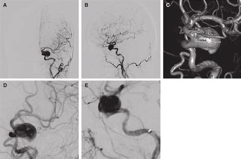 Preoperative left internal carotid angiogram. (A) Anteroposterior and ...