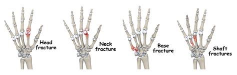 Metacarpal Fracture | Local Physio | Local Physio