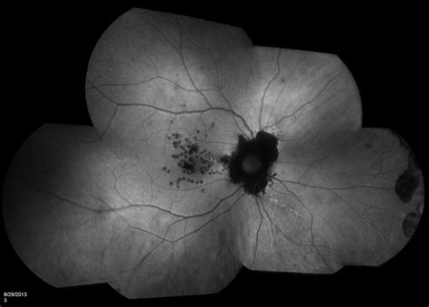 Cystoid Macular Edema - Retina Image Bank