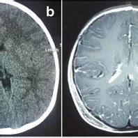 a Brain CT scan showing fracture right parietal bone with... | Download Scientific Diagram